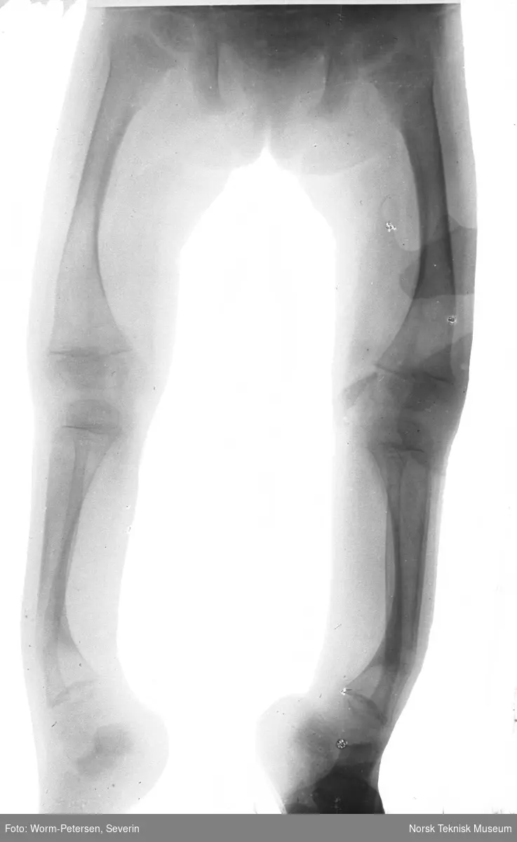 Røntgenbilde av hjulbent underkropp