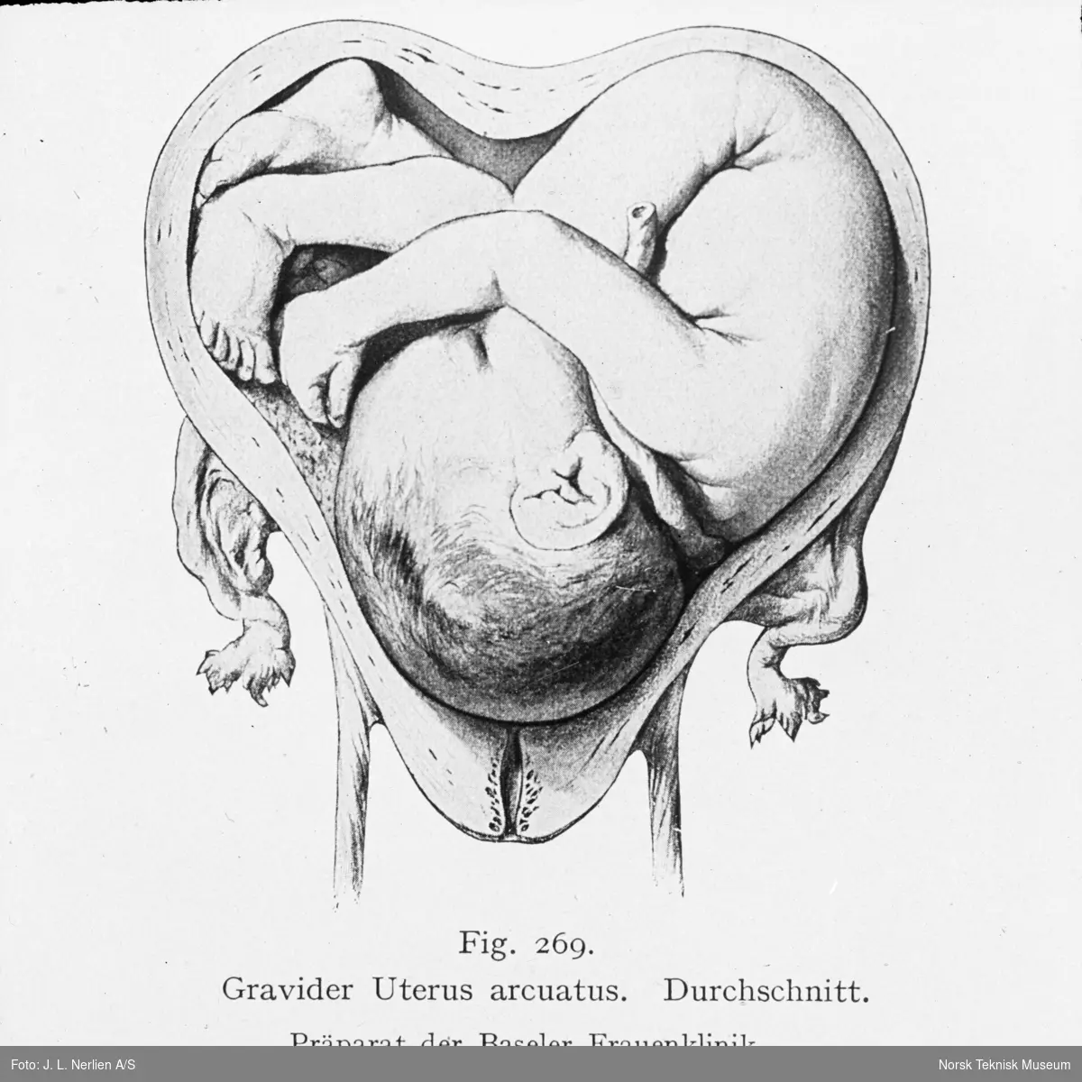 Avfotografert tegning av en konkav livmor med foster