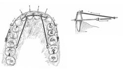 Illustrasjon, tannprotese